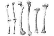 Comment Soigner Les Rhumatismes Articulaires?