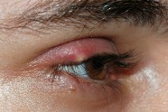 Comment Soigner Un Orgelet Naturellement?