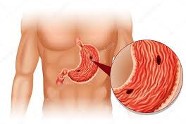 Comment Traiter Un Ulcère D'estomac?